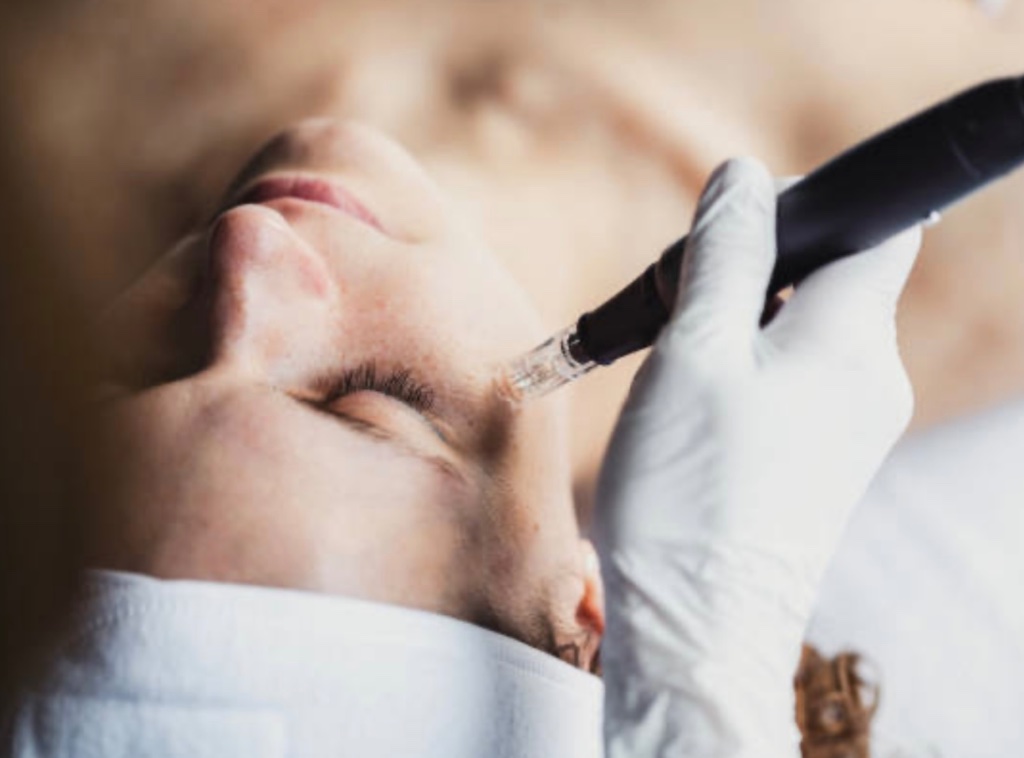PRP hair restoration treatment at ReGen Aesthetics Clinic Merthyr Tydfil