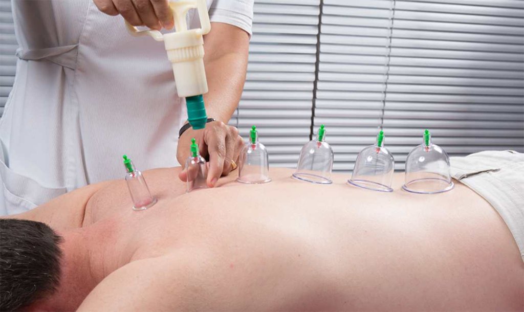 الحجامة الطبية - Cupping