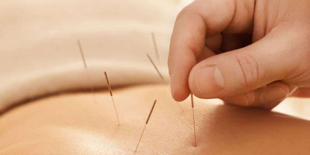 الإبر الصينية الجافة - Dry Needling