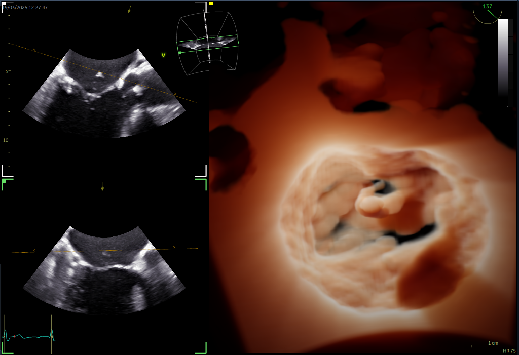 Transesophageal Echocardiography TOE