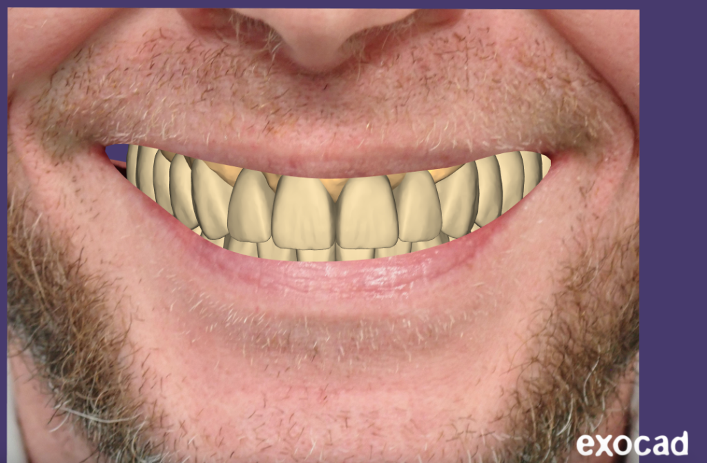 Integrated digital workflow for All-on-4 dental implants — Advanced Dentistry & Implants Littleton