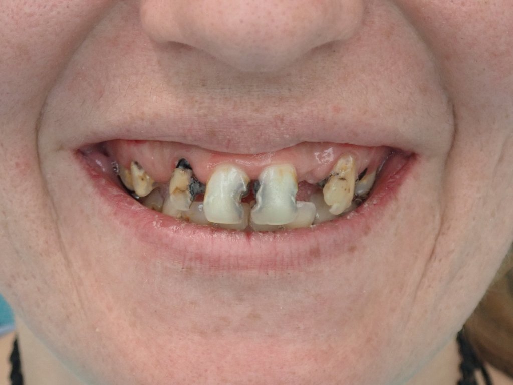 Before Upper Arch Restoration — Severe Decay & Failing Teeth — dental implant patient Littleton CO