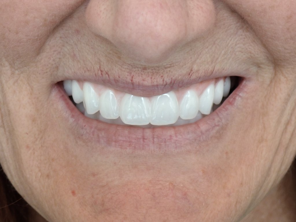 All-on-4 dental implant patient smile transformation Littleton CO