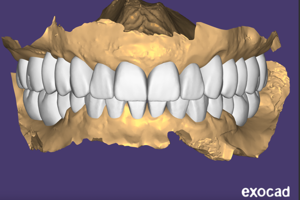 All-on-4 healing phase — 3D digital treatment planning Advanced Dentistry Implants Littleton CO