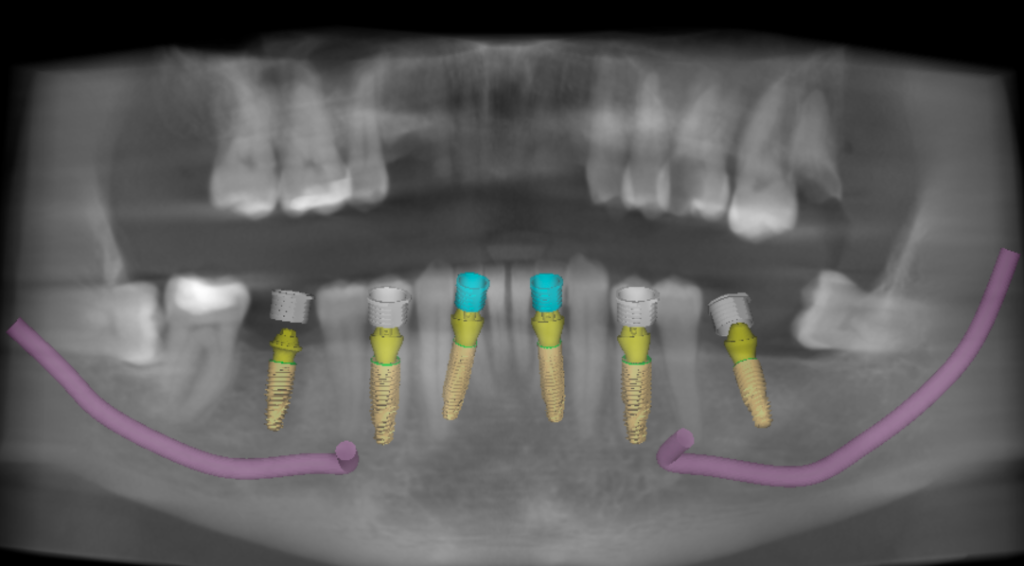 Computer-guided surgical planning for All-on-4 dental implants Littleton CO