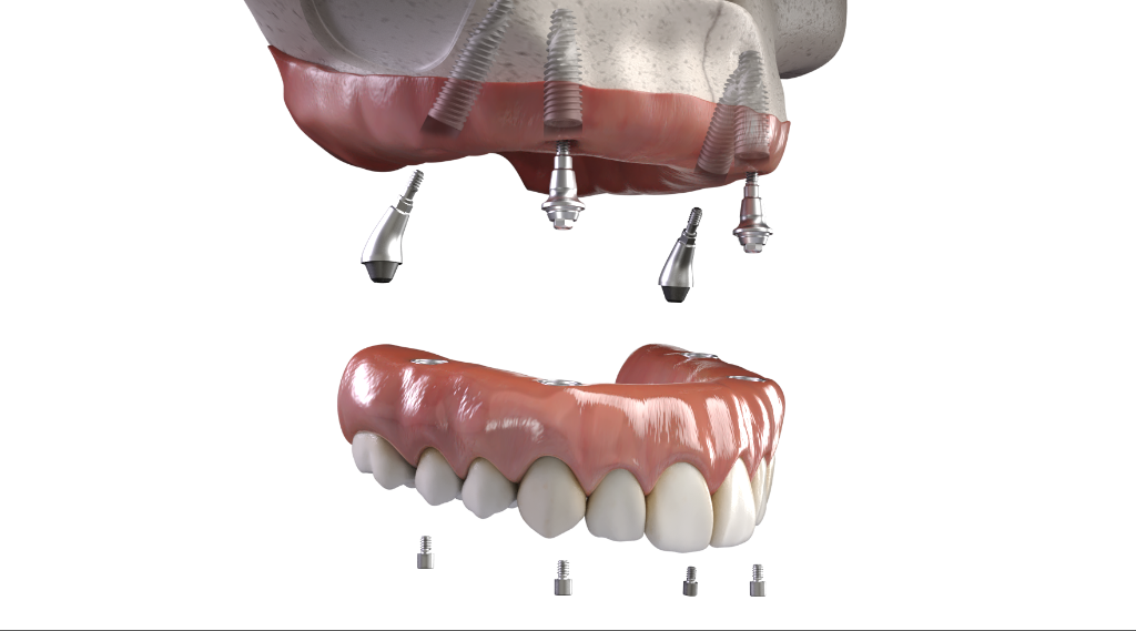 3D model showing full-arch dental implants supporting a fixed prosthetic arch Littleton CO