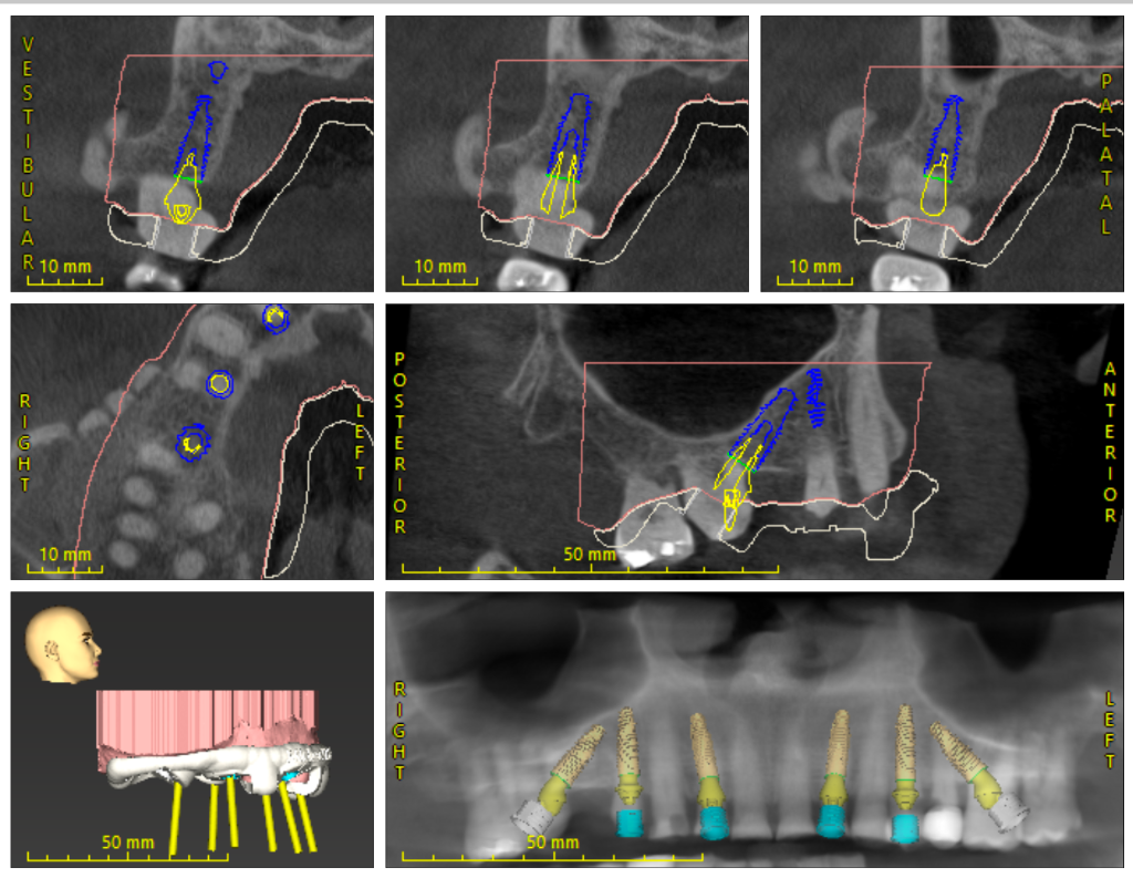 CBCT 3D imaging for All-on-4 dental implant planning Littleton CO — Advanced Dentistry & Implants
