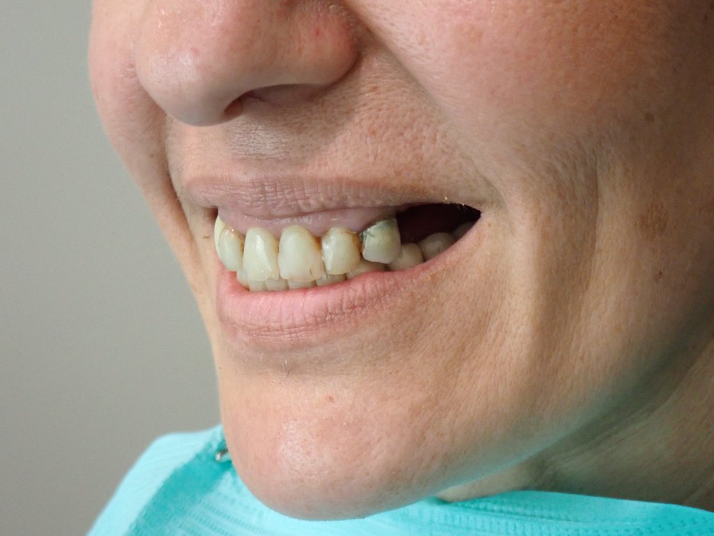 Before - All-on-X full arch dental implant transformation — failing teeth replaced with permanent implant-supported smile in Littleton CO
