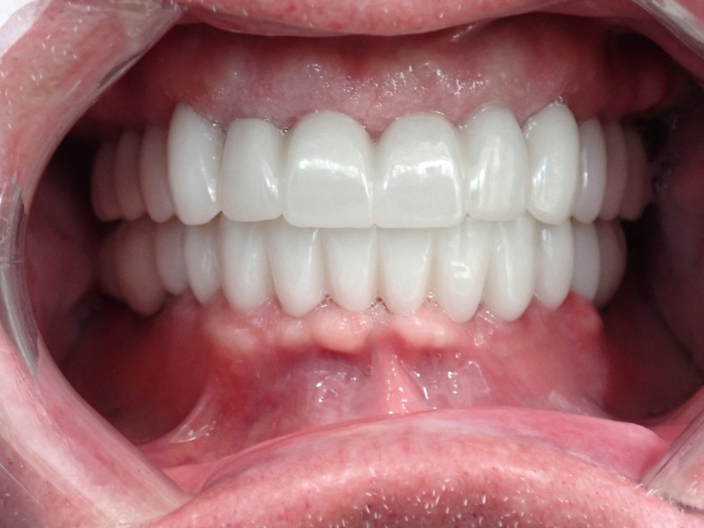 After - Complete full mouth dental implant transformation — All-on-X before and after results Advanced Dentistry & Implants Littleton Colorado
