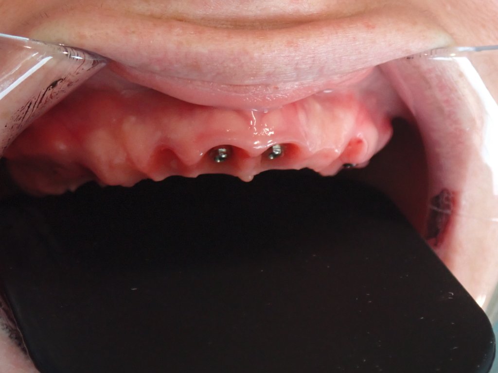 Before - All-on-X upper arch restoration before and after — full arch dental implants by Dr. Mohager at Advanced Dentistry & Implants Littleton CO