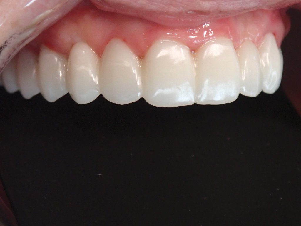 After - All-on-X upper arch restoration before and after — full arch dental implants by Dr. Mohager at Advanced Dentistry & Implants Littleton CO