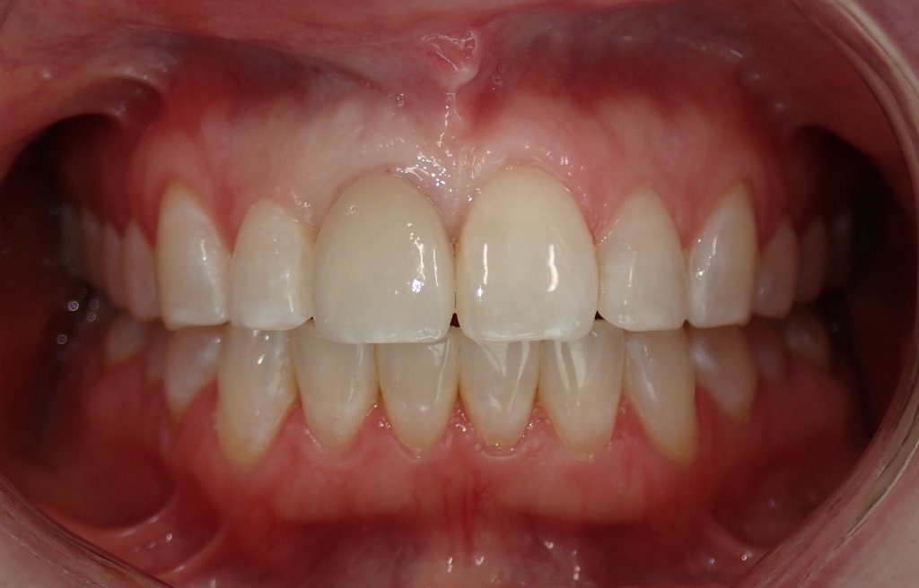 After - Single tooth dental implant before and after — missing tooth replaced with natural-looking implant crown by Dr. Mohager in Littleton CO