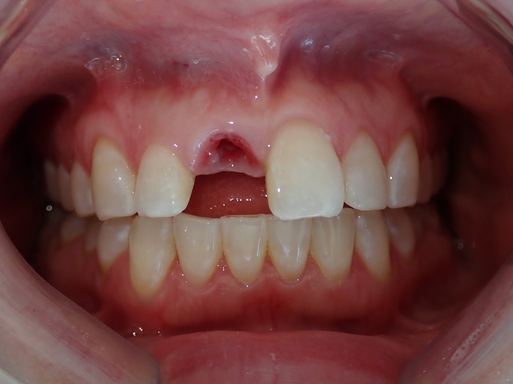 Before - Single tooth dental implant before and after — missing tooth replaced with natural-looking implant crown by Dr. Mohager in Littleton CO