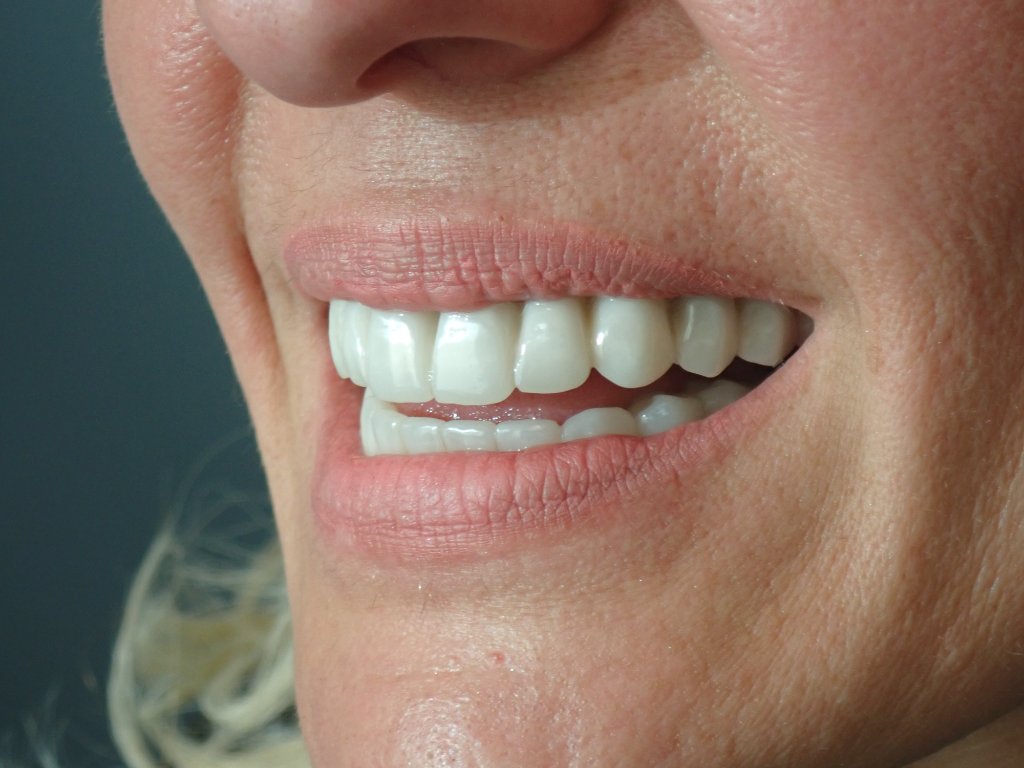 After - All-on-X full arch dental implant transformation — failing teeth replaced with permanent implant-supported smile in Littleton CO