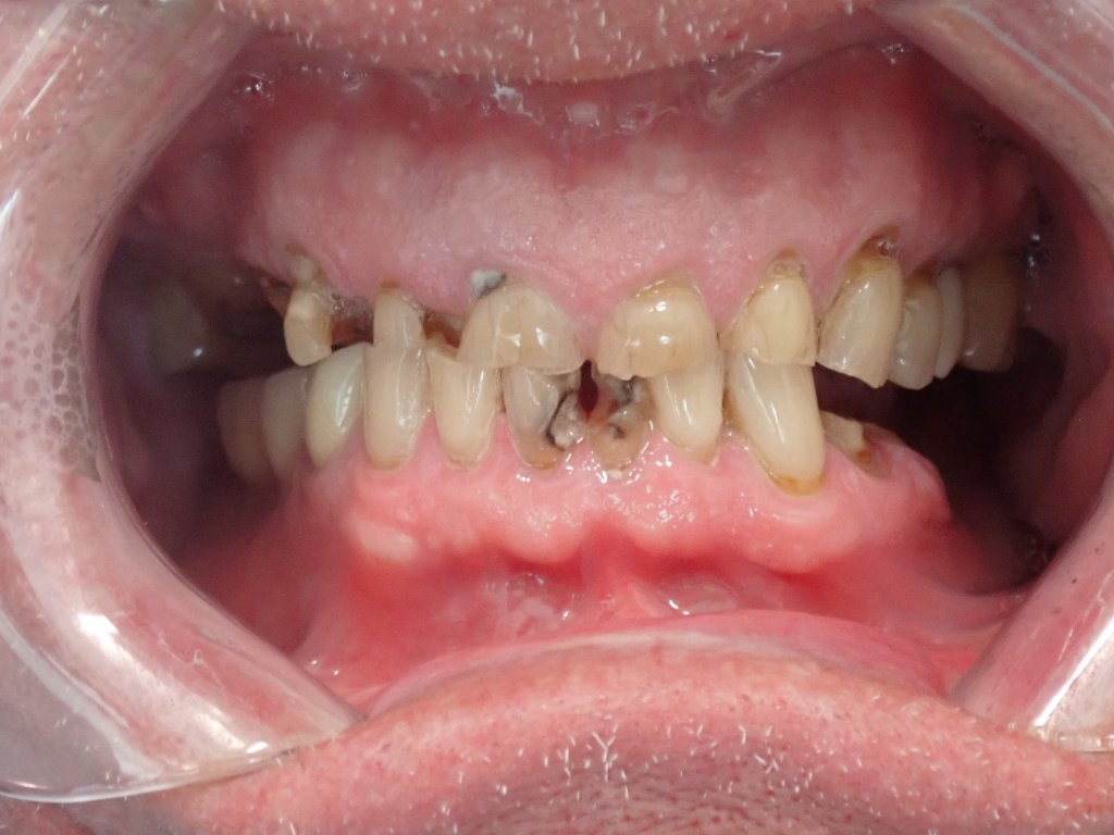 Before - Complete full mouth dental implant transformation — All-on-X before and after results Advanced Dentistry & Implants Littleton Colorado