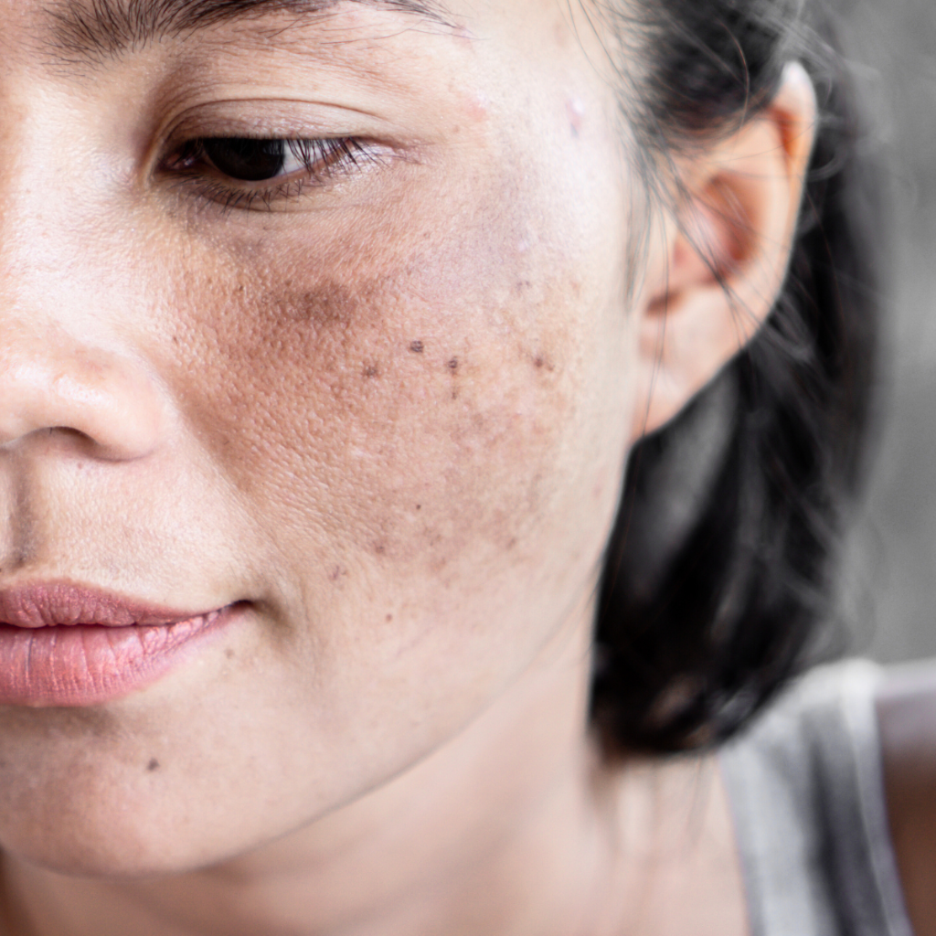 Pigmentation