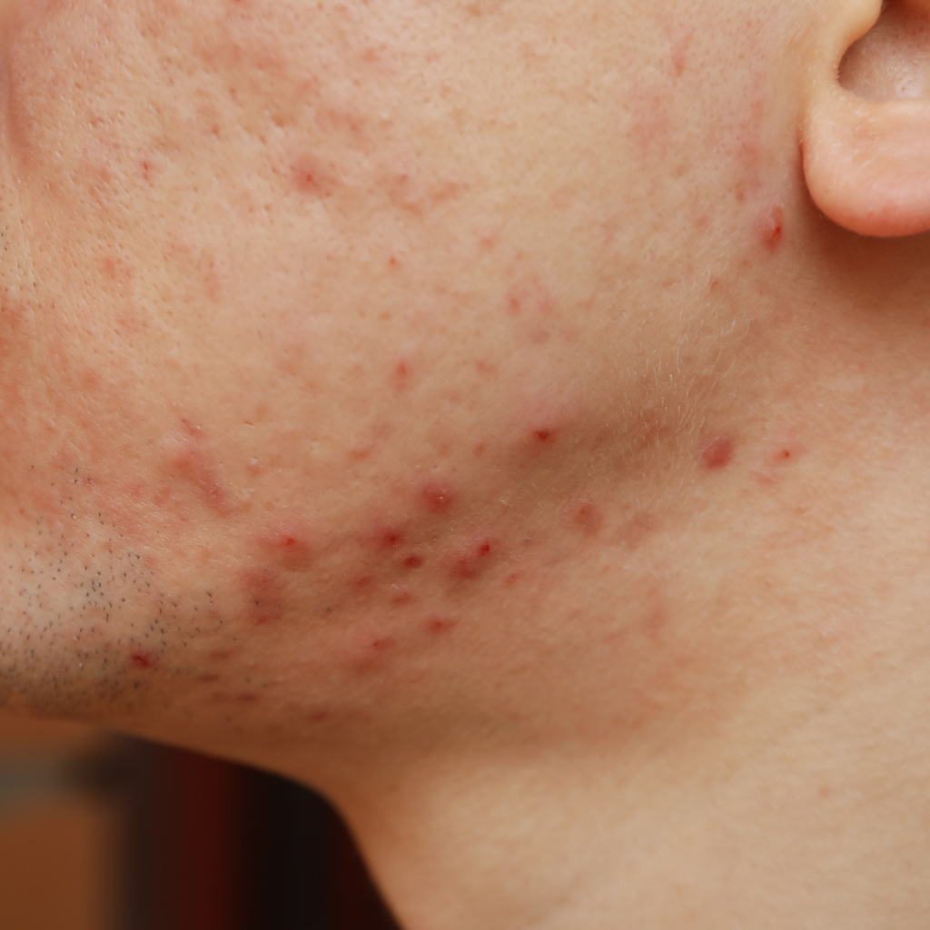 Acne