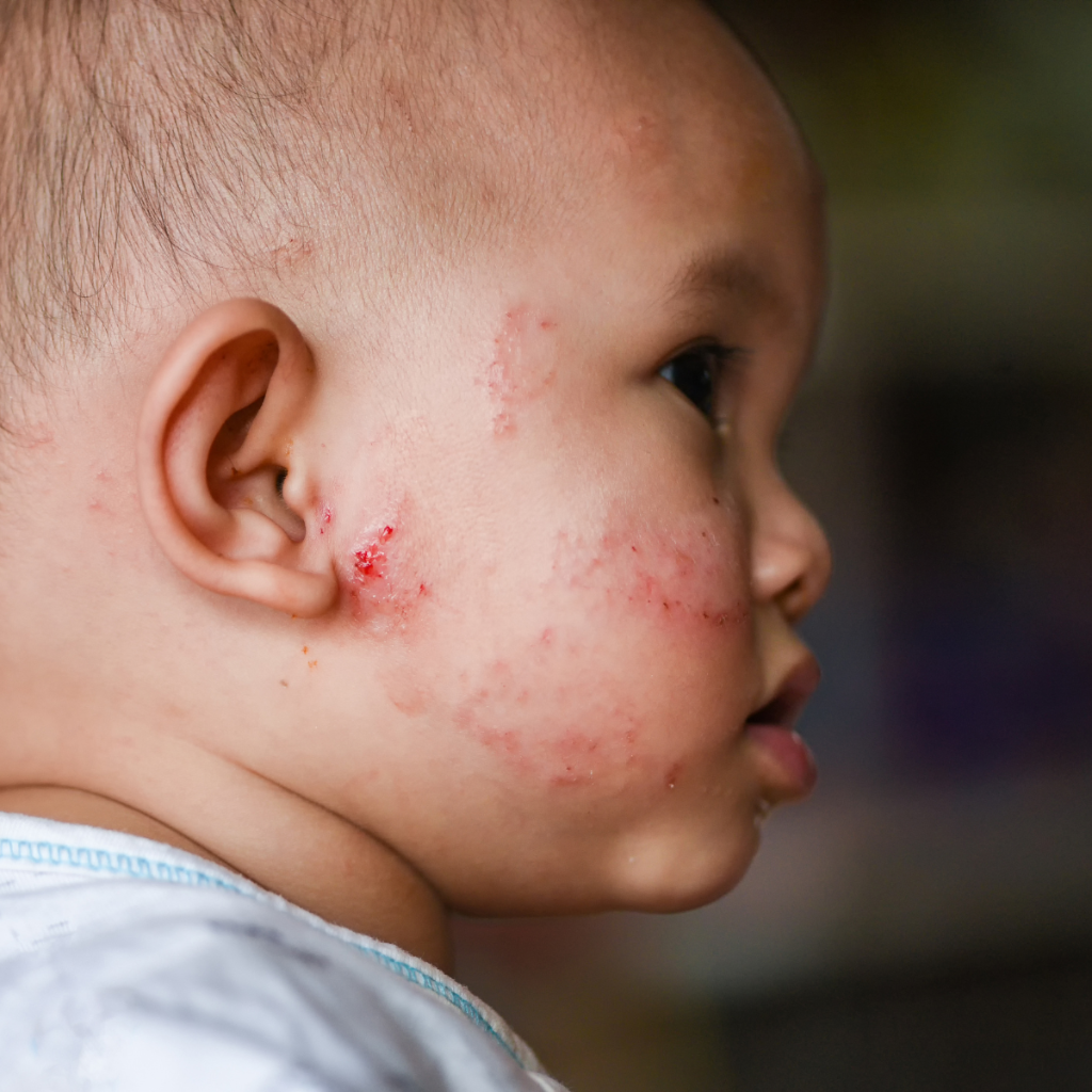 Eczema