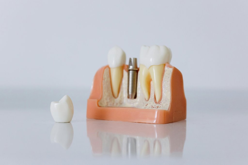 Implante dentário