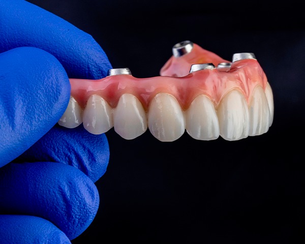 Prótese protocolo sobre implantes