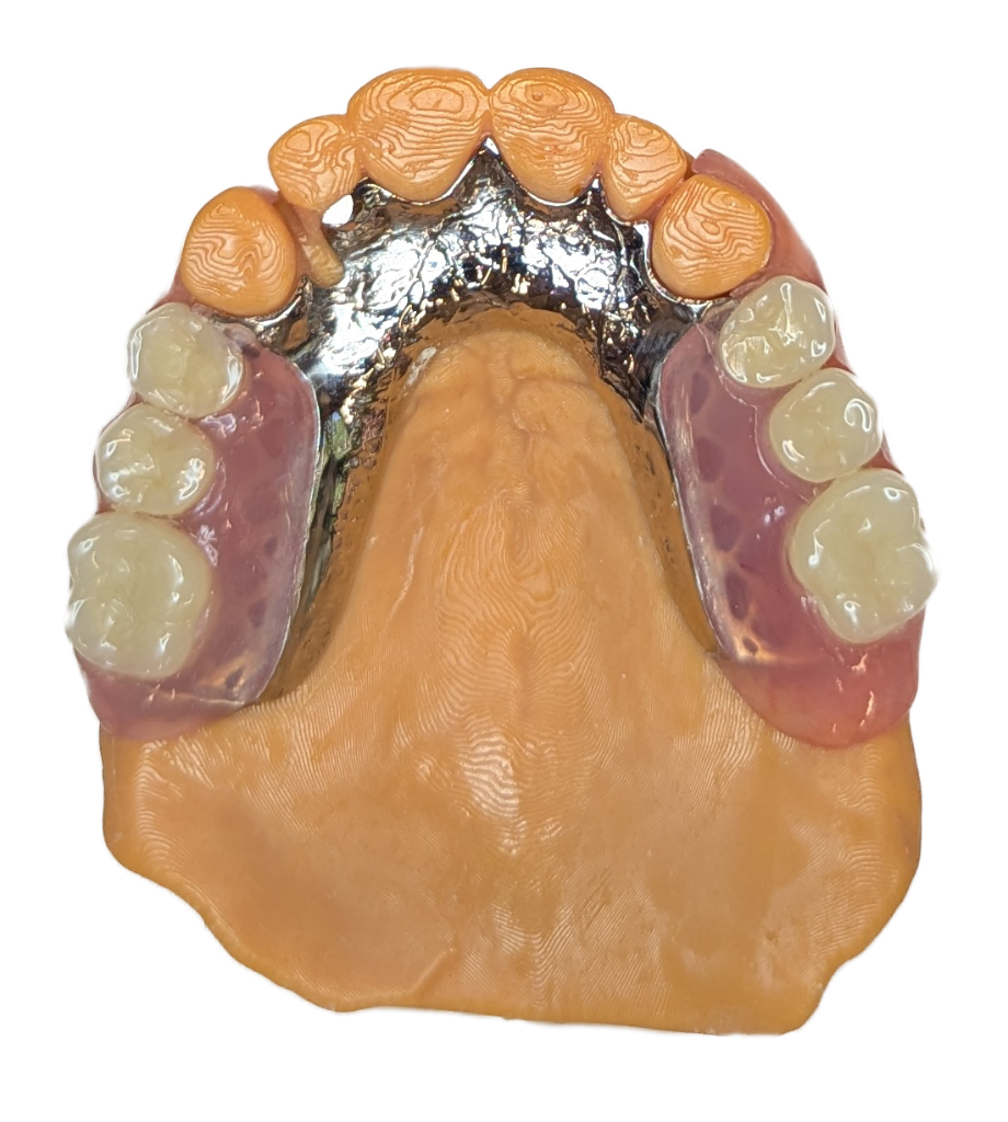 Partial cast chrome denture
