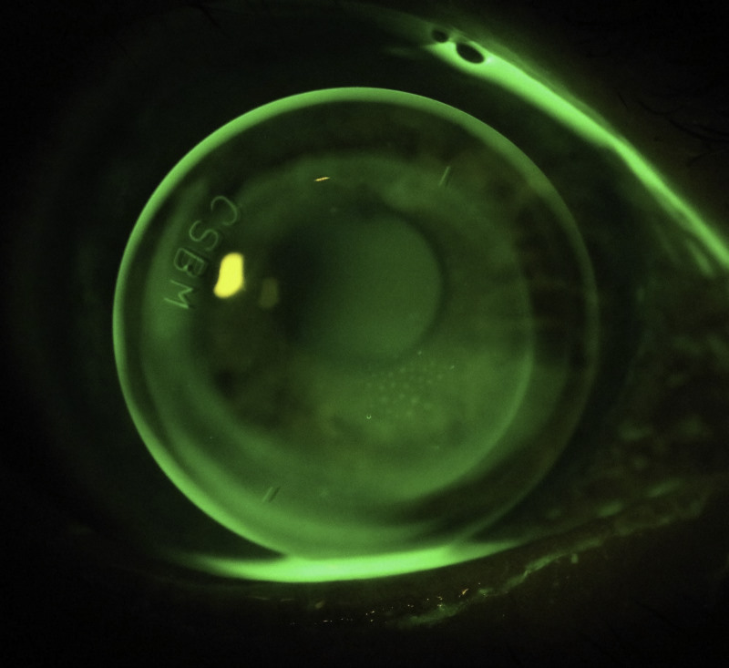 Corneal RGP
