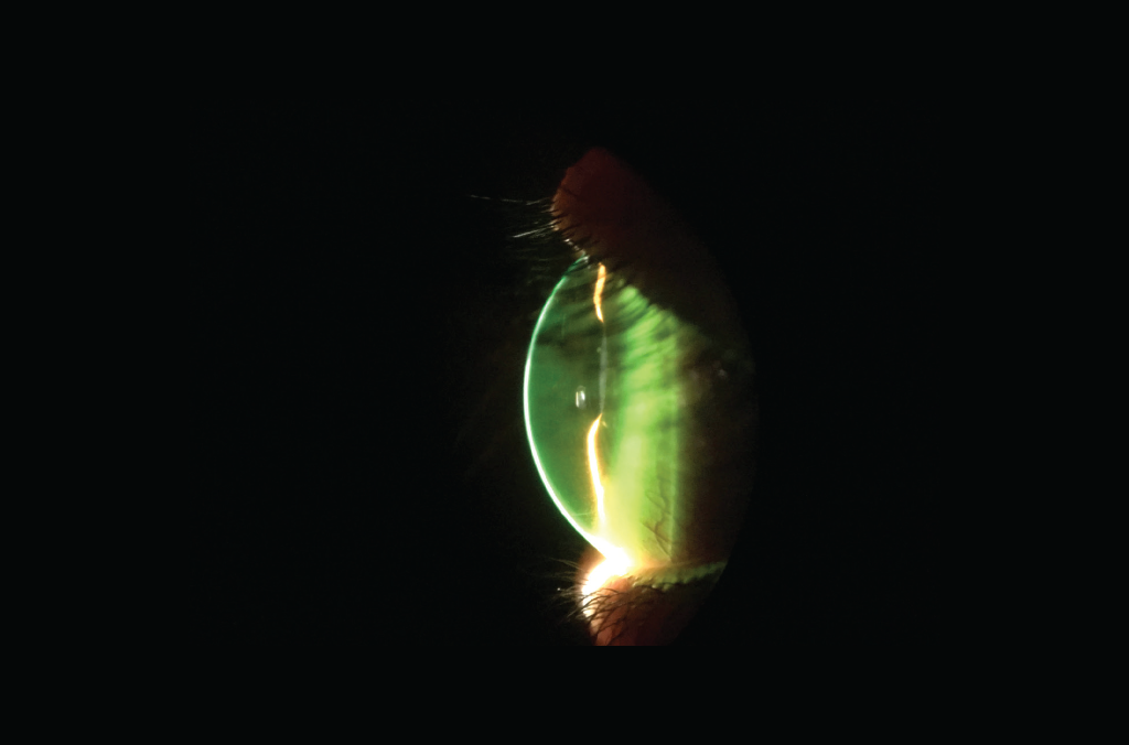 Scleral Lenses