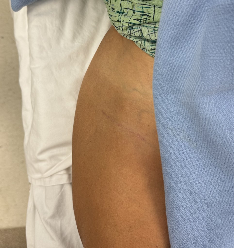 Bikini Incision Example - 2 months post-surgery