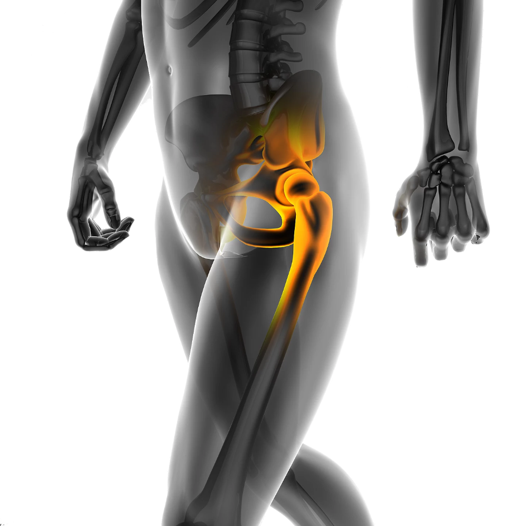 Hip Replacement